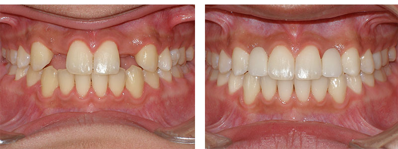 Absent lateral incisors
